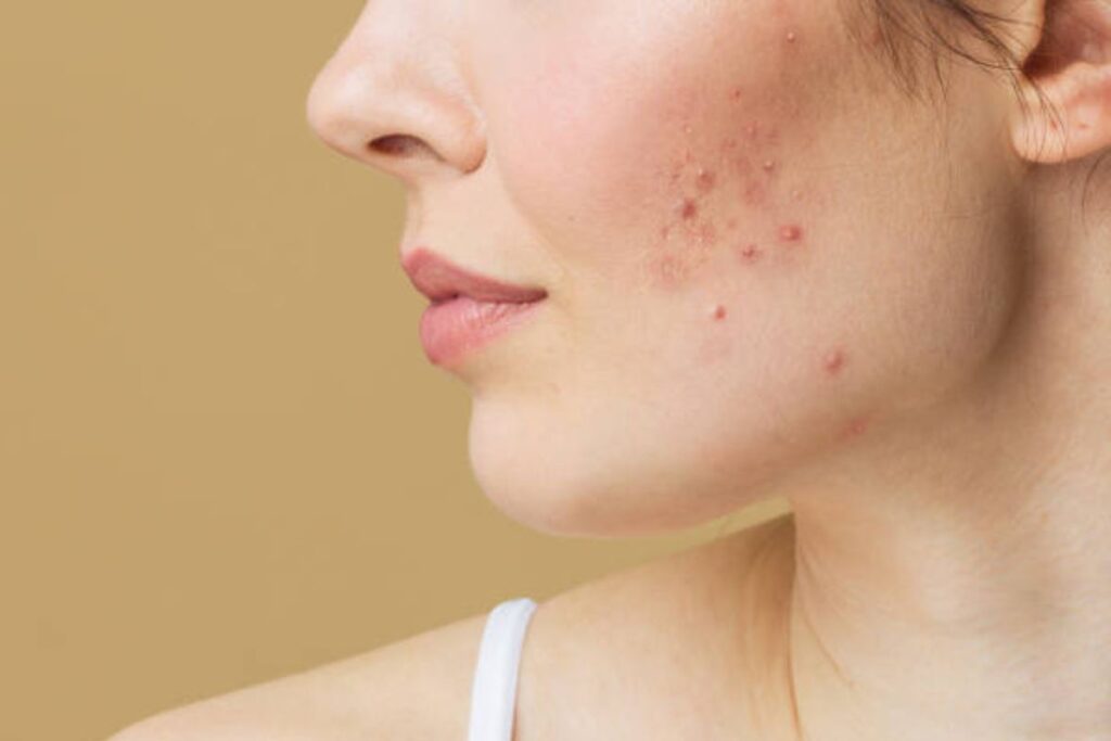 Acne