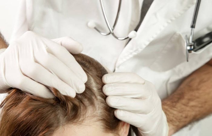 Understanding Scarring Alopecia