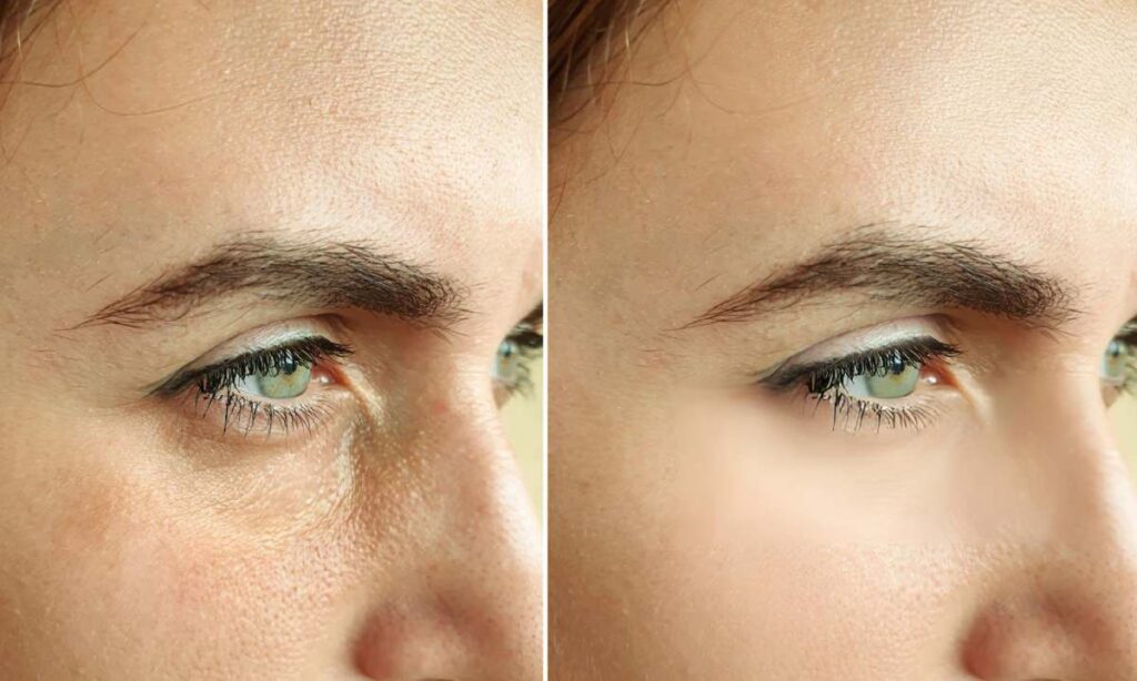 Under-Eye Lines